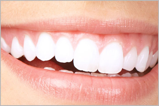 Laser Teeth Whitening Hollywood Smile 