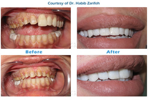 Hollywood smile Cerec veneers in Beirut Lebanon