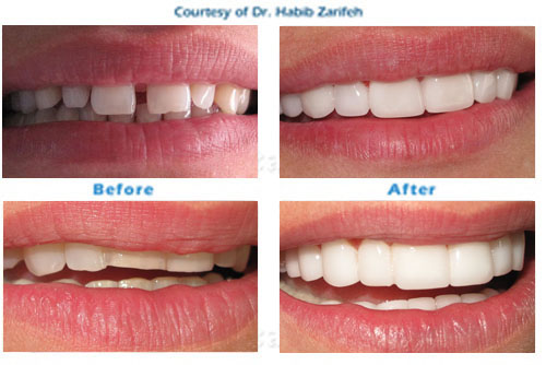 Hollywood smile Lumineers in Beirut Lebanon