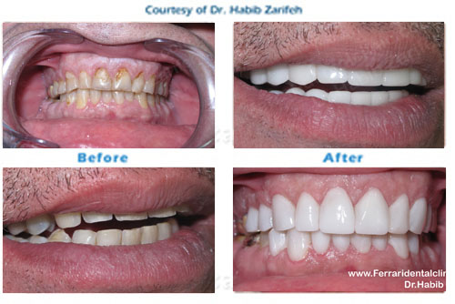 Hollywood smile Composite veneers in Beirut Lebanon