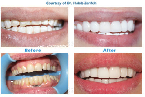 Hollywood smile Veneers in Beirut Lebanon