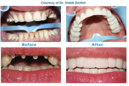 Hollywood smile Zirconium crowns in Beirut Lebanon