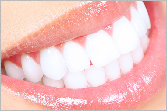 Teeth Whitening Hollywood Smile